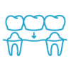 dental bridge